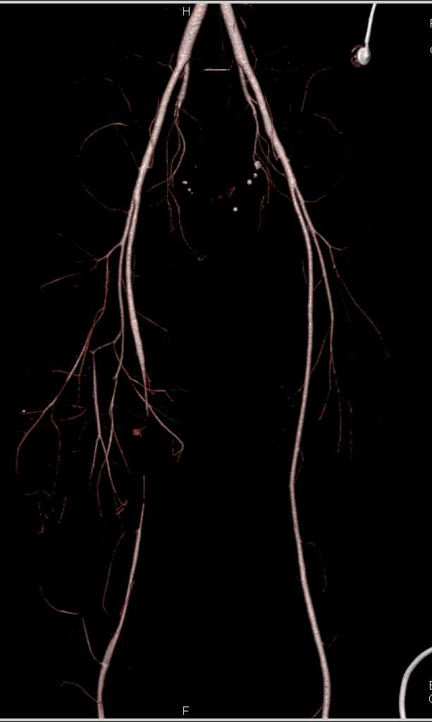 Gunshot Wound (GSW) Thigh with Active Bleed and CTA - CTisus CT Scan