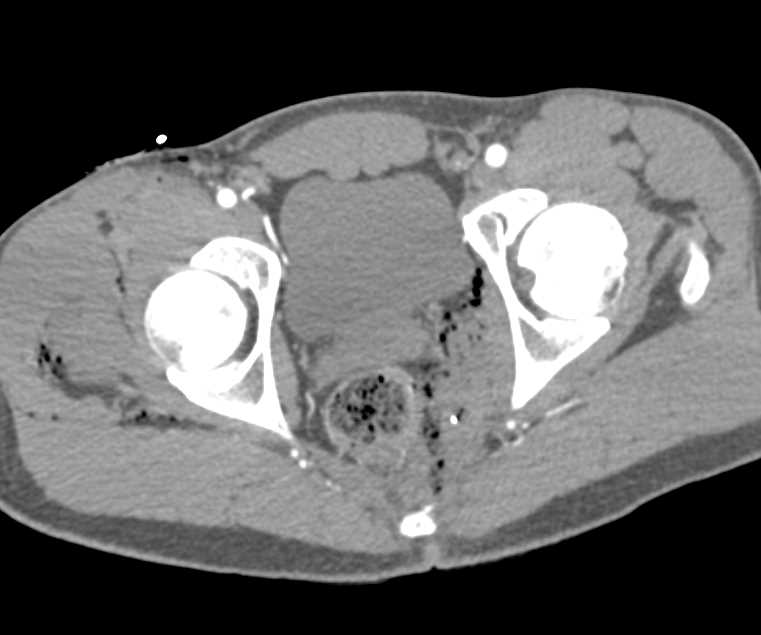 Gunshot Wound (GSW) with Pelvic Hematoma - CTisus CT Scan