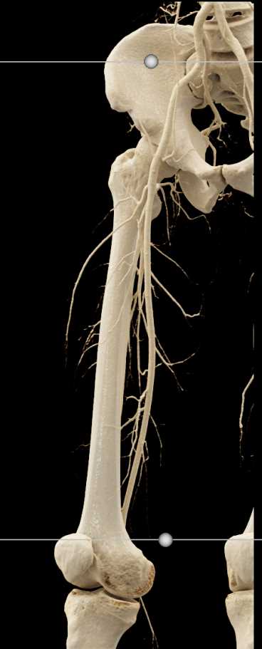 Stab Wound Thigh Without Vascular Injury - CTisus CT Scan