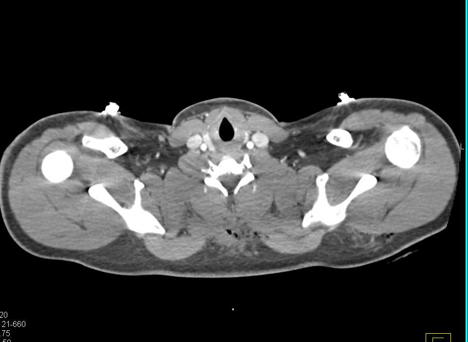 Stab Wound Back Without Vascular Injury - CTisus CT Scan