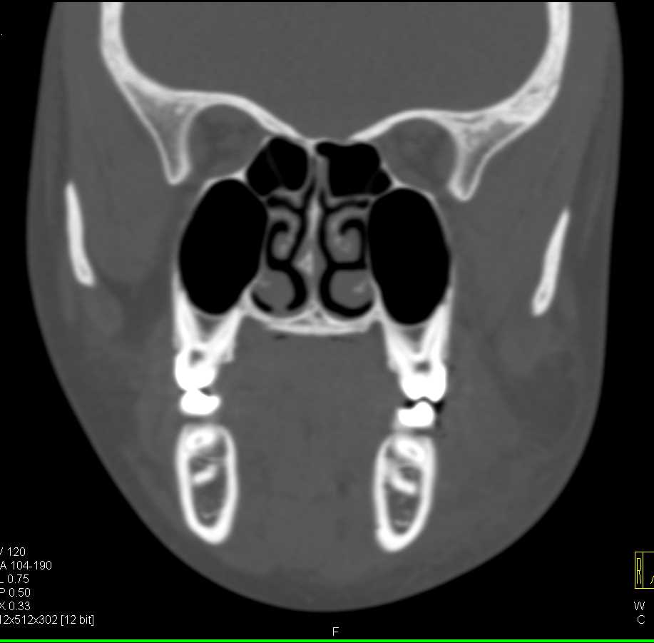 Mandibular Fracture with Repair - CTisus CT Scan