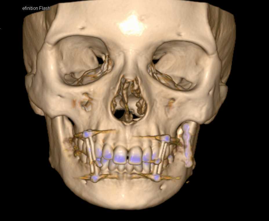Mandibular Fracture with Repair - CTisus CT Scan