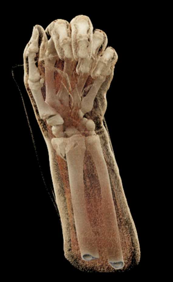 Distal Radius and Ulna Fractures with Cinematic Rendering - CTisus CT Scan