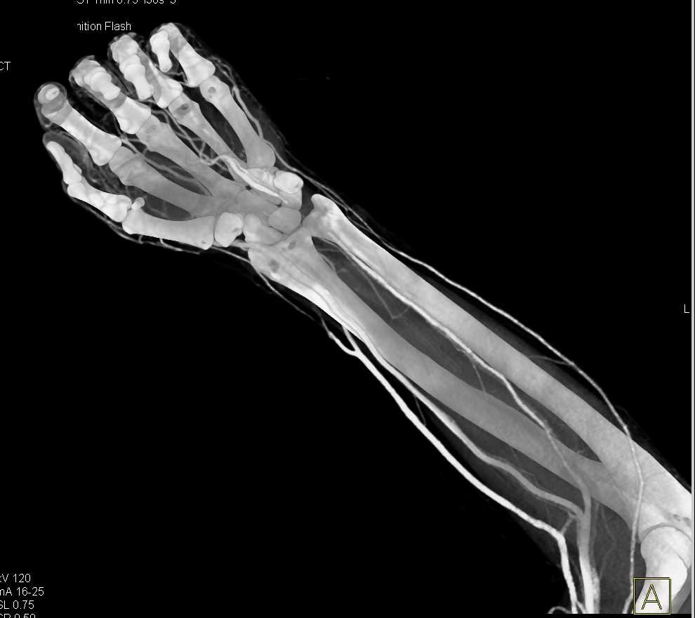 Laceration Thru the Wrist with CTA - CTisus CT Scan