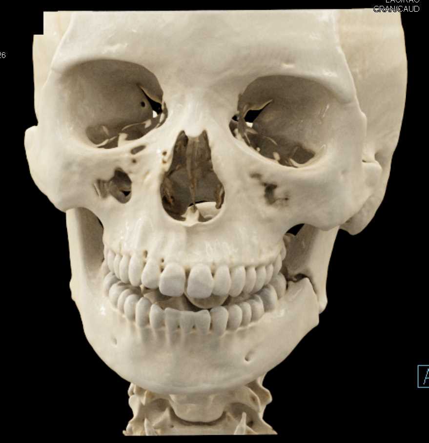 Mandibular Fracture - CTisus CT Scan
