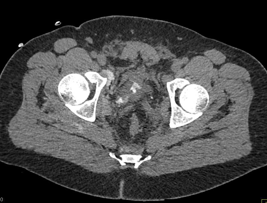 Gunshot Wound (GSW) Pelvis with Fracture and Bladder Trauma - CTisus CT Scan