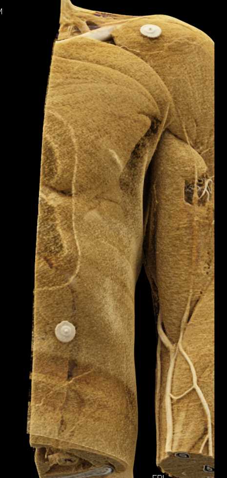 Trauma Right Shoulder with Muscle Injury - CTisus CT Scan