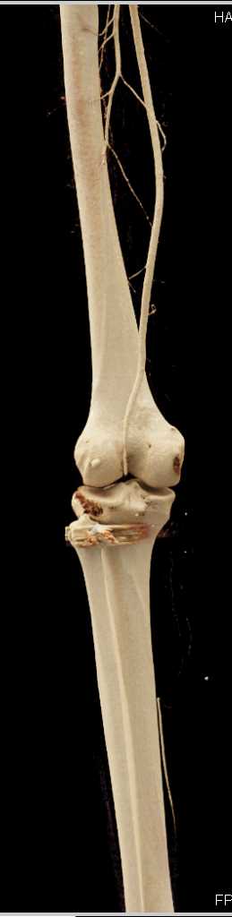 Gunshot Wound (GSW) Thigh Without Vascular Injury using Cinematic Rendering - CTisus CT Scan