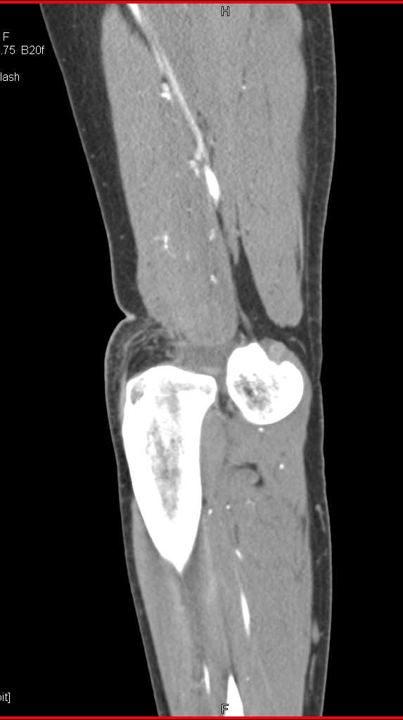 Fracture Dislocation at the Knee Joint - CTisus CT Scan