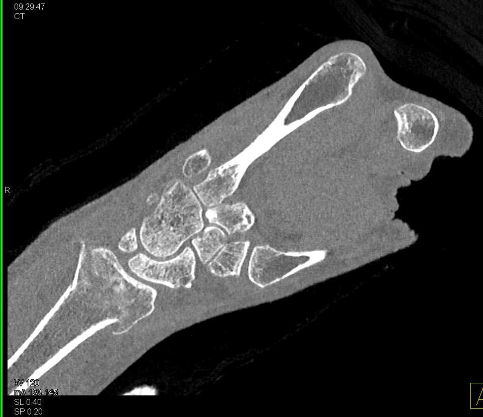 Distal Radius Fracture - CTisus CT Scan