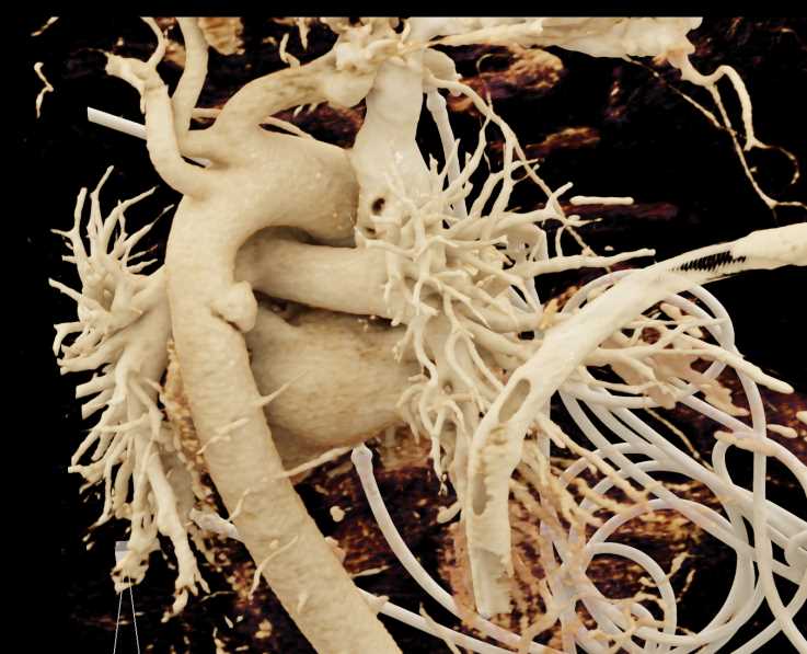 Aortic Transection Post Trauma - CTisus CT Scan