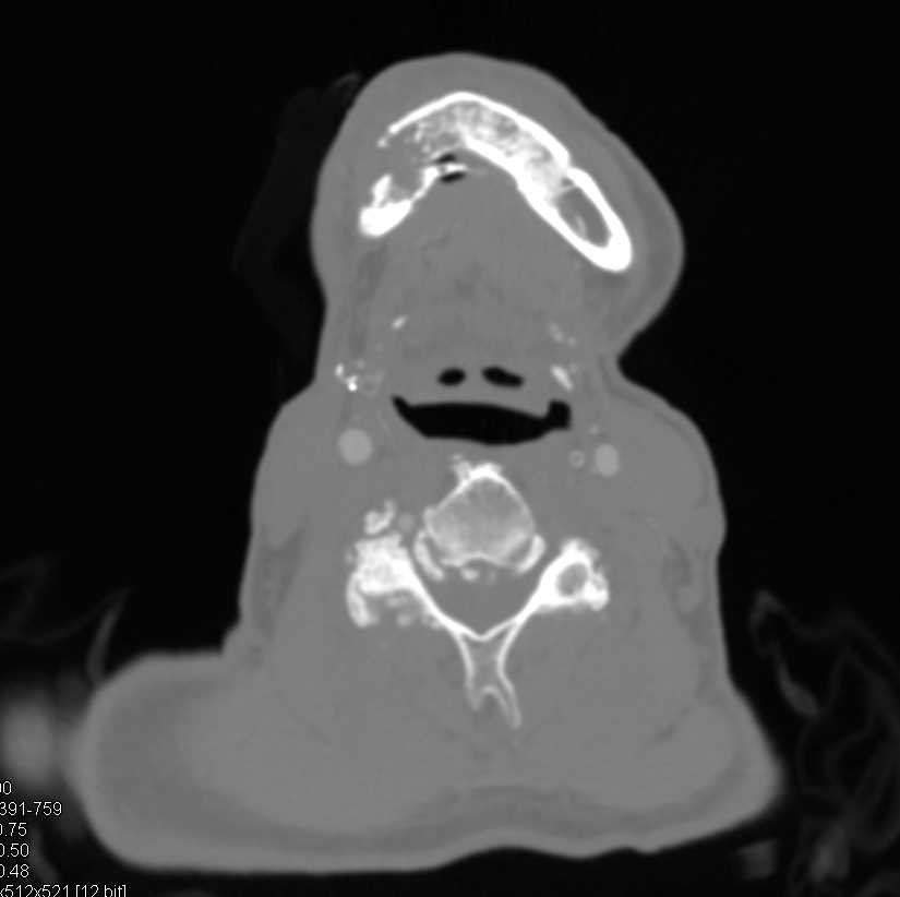Mandibular Fractures - CTisus CT Scan
