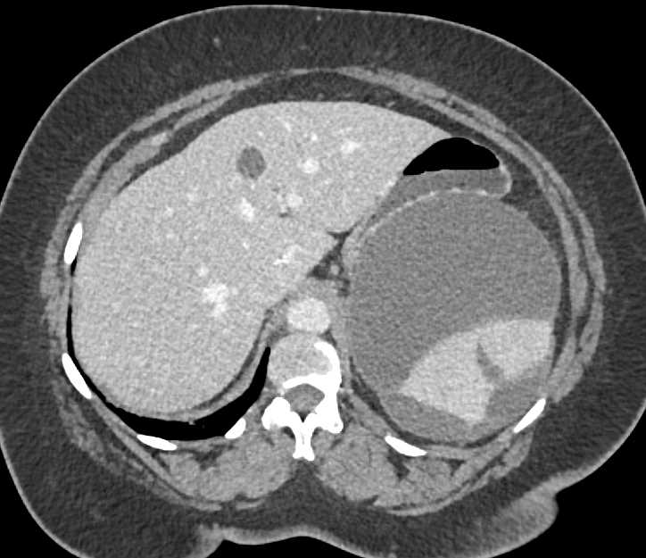 Splenic Laceration with Subcapsular Hematoma - CTisus CT Scan