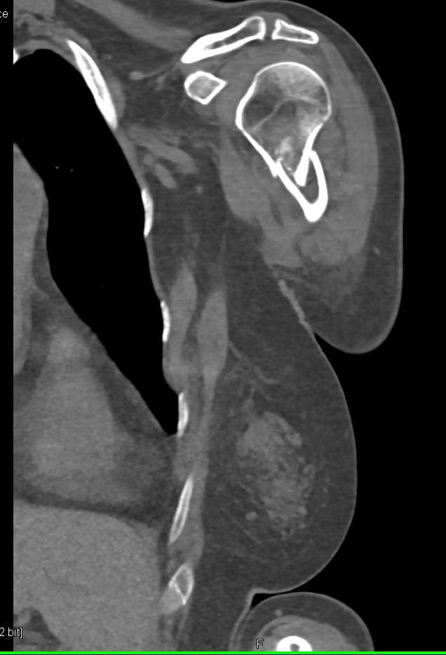 Fracture Neck of the Humerus - CTisus CT Scan
