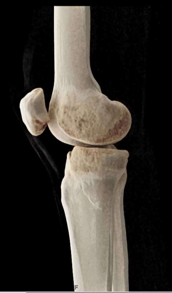 Tibial Plateau Fracture - CTisus CT Scan