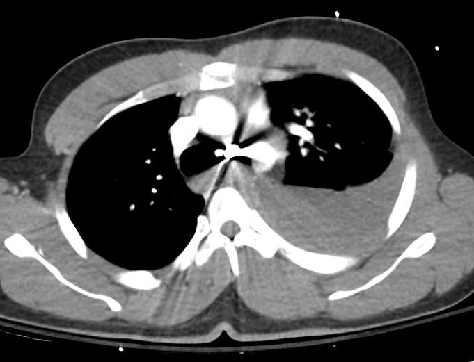 GSW to Chest with Aortic Laceration and Active Bleed - CTisus CT Scan