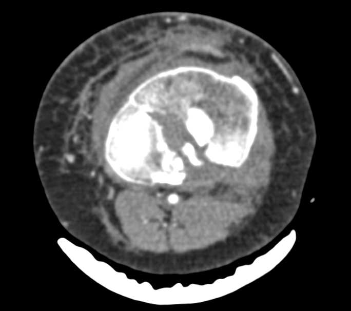 Tibiial Plateau Fracture - CTisus CT Scan