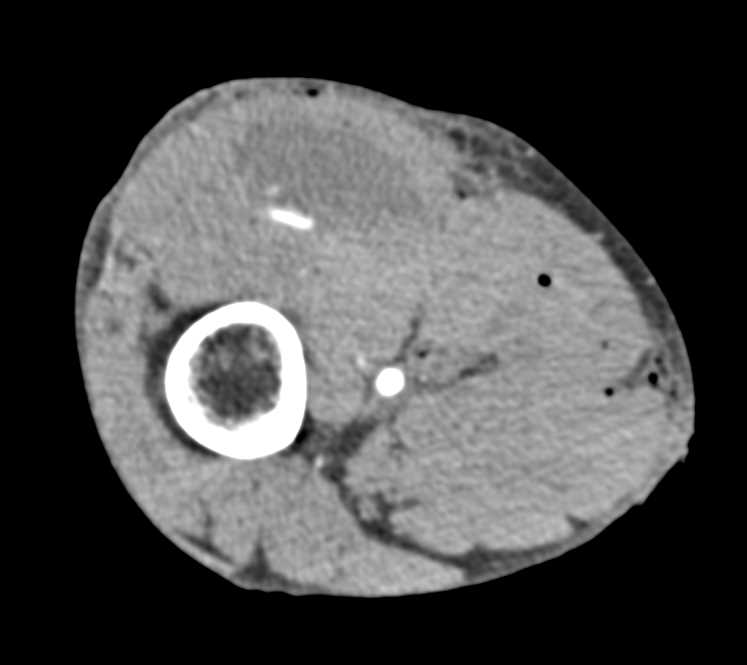 CTisus CT Scanning | GSW with Bleed Near Knee