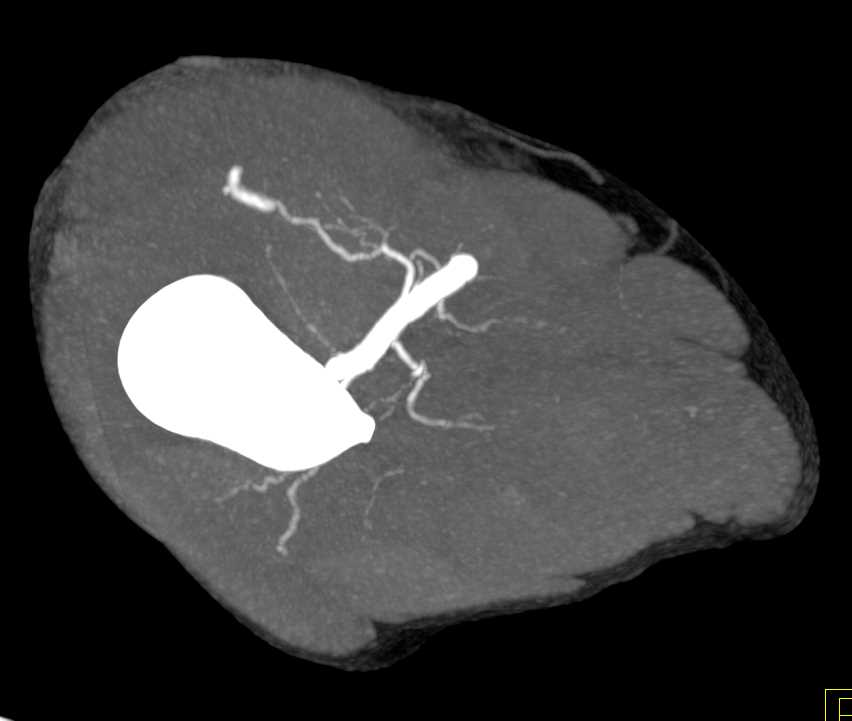 GSW with Bleed Near Knee - CTisus CT Scan