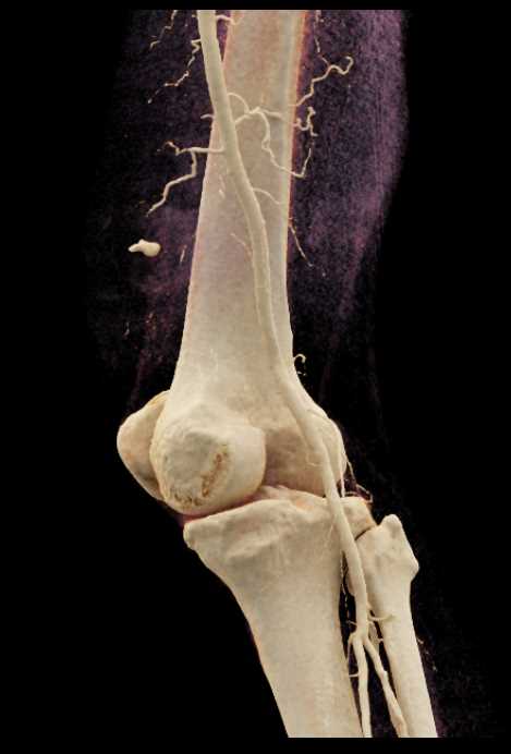 Trauma to Knee with Intact Popliteal Artery - CTisus CT Scan