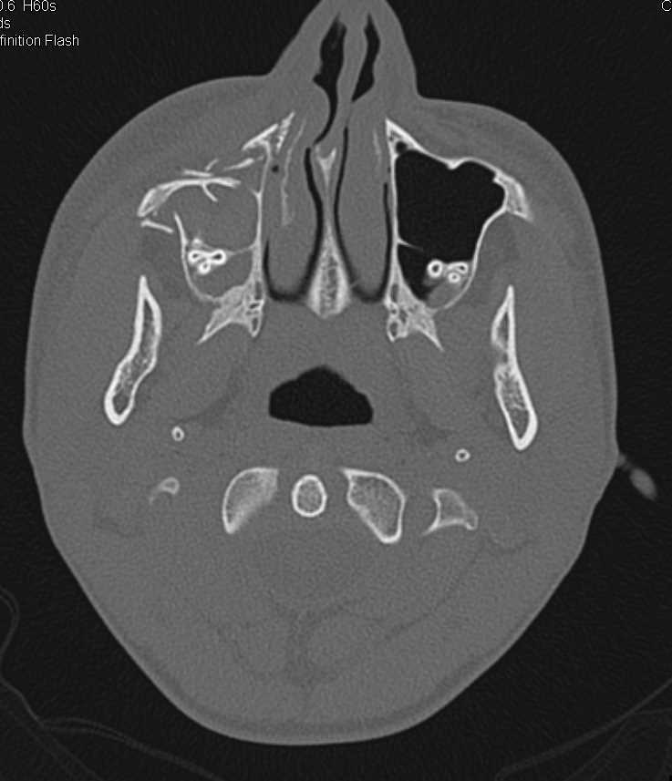 Right Orbital Fracture - CTisus CT Scan