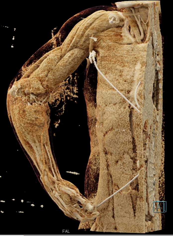 GSW Shoulder with Muscular Injury - CTisus CT Scan