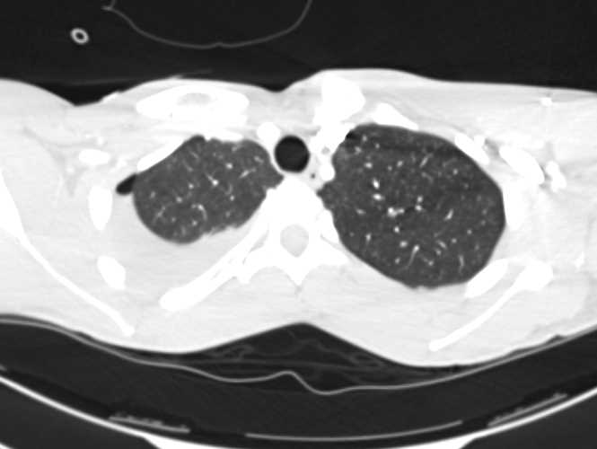 Trauma with Pneumothorax and Liver Laceration - CTisus CT Scan