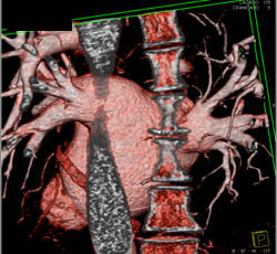 Pulmonary Veins - CTisus CT Scan