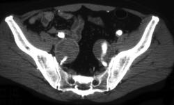 Thrombosed Iliac Artery Aneurysms - CTisus CT Scan