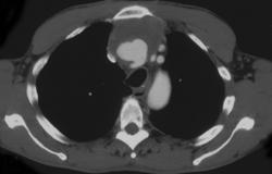 Pseudoaneurysm at Site of Anastomosis for Cab - CTisus CT Scan