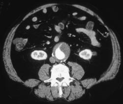 Aortic Aneurysm - CTisus CT Scan