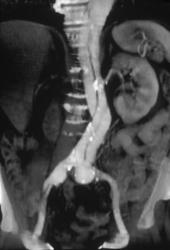 Aortic Dissection - CTisus CT Scan