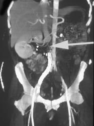 Retroperitoneal Fibrosis - CTisus CT Scan