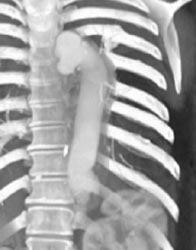 Ductus Aneurysm Due to Prior Trauma - CTisus CT Scan