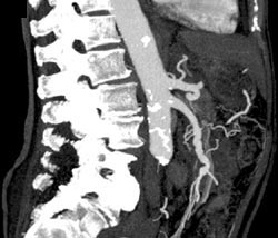 Patent SMA and Celiac Axis - CTisus CT Scan