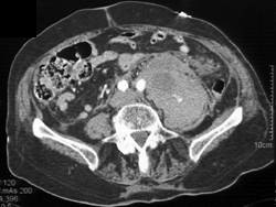 Active Extravasation With Hematoma in Psoas Muscle - CTisus CT Scan