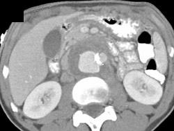 Perianeurysmal Fibrosis With Pseudoaneurysm - CTisus CT Scan