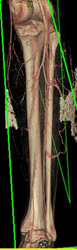 Ct Angiogram - CTisus CT Scan