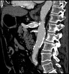 Celiac Artery Aneurysm - CTisus CT Scan