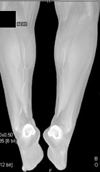 Runoff Study - CTisus CT Scan