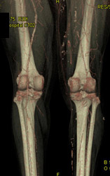 Diseased Popliteal Arteries Evaluated for Potential Graft - CTisus CT Scan