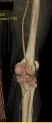 Popliteal Artery Aneurysm - CTisus CT Scan
