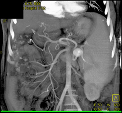 Splenic Artery Aneurysm - CTisus CT Scan