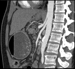 Median Arcuate Ligament Syndrome - CTisus CT Scan