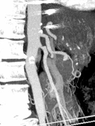 Superior Mesenteric Artery (SMA) Stenosis - CTisus CT Scan
