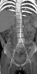 Small Iliac Vessels - CTisus CT Scan