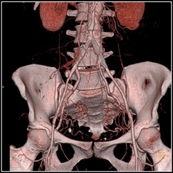 Stents in Iliac Arteries - CTisus CT Scan