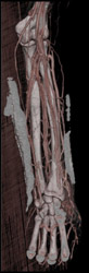 Normal CTA Elbow - CTisus CT Scan
