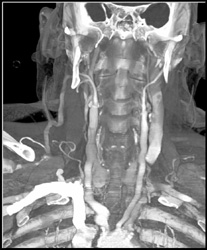Diseased Carotid Artery - CTisus CT Scan