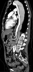 Aortic Dissection - CTisus CT Scan